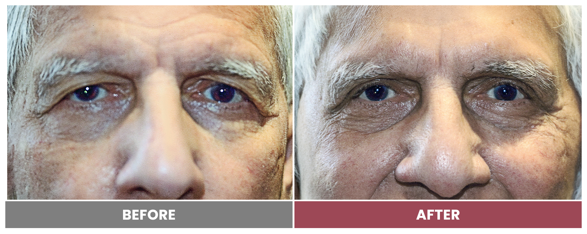 Upper Blepharoplasty - Case 57